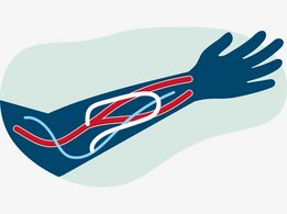 Изображение сосудистого протеза